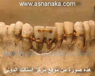 asnanaka_branemark2.jpg